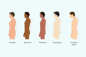 5 Types of Posture Problems & How to Fix Your Posture – BackEmbrace